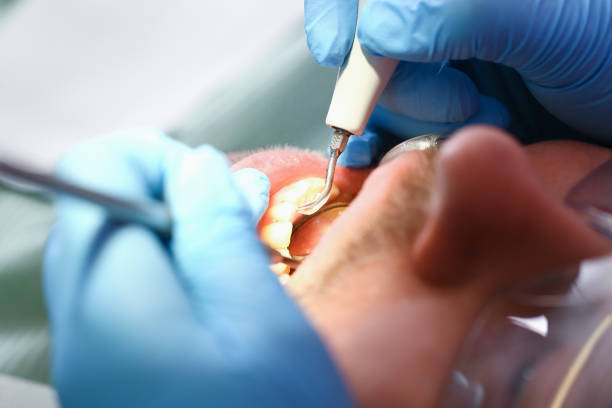 Best Emergency Wisdom Teeth Removal in Galion, OH